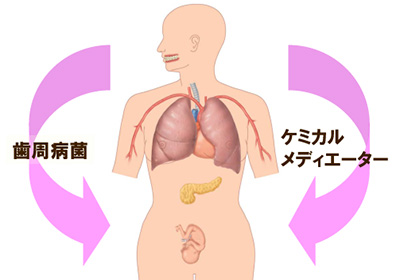 歯周病が全身をむしばむ