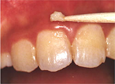 歯周病の大きな原因