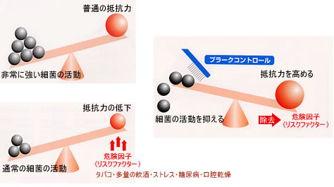 歯周病の予防法・治療法